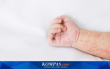 Campak Bisa Sebabkan Pneumonia dan Radang Otak, Waspadai Komplikasi Serius