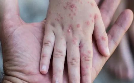 Kasus Campak Meningkat di Indonesia, Ternyata Lebih Menular dari COVID-19