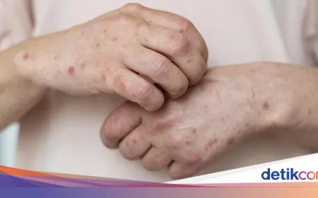 Kasus Campak di Jabar Melonjak, Warga Diminta Waspada Saat Mudik Idul Fitri 2026