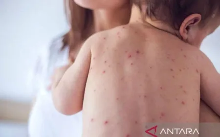 Komplikasi Campak pada Anak Meningkat di Indonesia, Ini Bahayanya