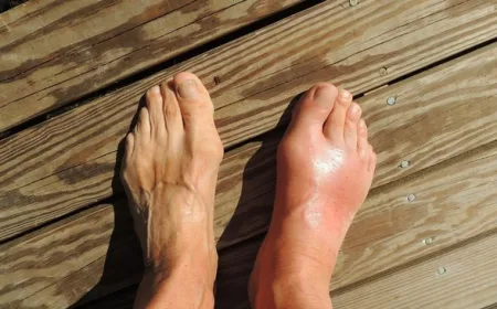 10 Makanan Tinggi Purin yang Harus Dihindari Pengidap Asam Urat