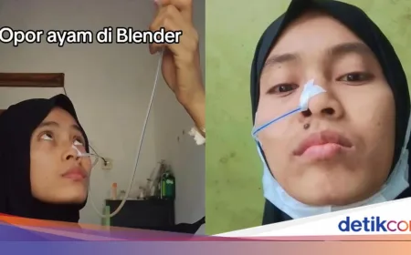 Kisah Viral Wanita Tasikmalaya Makan Lewat Selang karena Penyakit Akalasia Langka