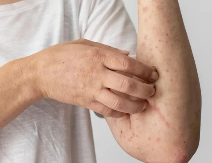 Kemenkes Ungkap Kronologi Dokter Meninggal Tertular Campak Saat Tugas di Cianjur