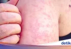 Efek Campak ke Otak Bisa Muncul 7 Tahun Setelah Terpapar, Guru Besar FKUI Wanti-wanti