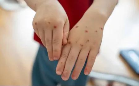 Bedanya Campak dan Rubella: Dokter PAPDI Jelaskan Gejala dan Risiko Penting