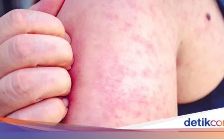 Efek Campak ke Otak Bisa Muncul 7 Tahun Setelah Terpapar, Guru Besar FKUI Wanti-wanti