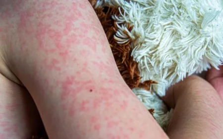 Wabah Campak di Bangladesh: 38 Anak Meninggal Karena Belum Divaksin