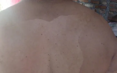 Penyakit Kulit di Punggung Ayah: Penyebab dan Cara Mengatasinya