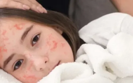 Waspada Penyakit Campak di Kerinci: Dinkes Lakukan Penelusuran Kasus secara Intensif