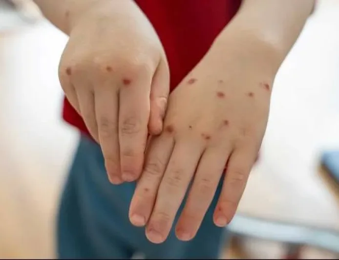 Bedanya Campak dan Rubella: Dokter PAPDI Jelaskan Gejala dan Risiko Penting