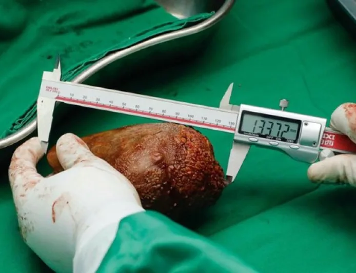 5 Makanan Perusak Ginjal Paling Cepat yang Harus Anda Hindari