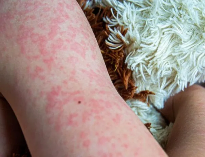 Wabah Campak di Bangladesh: 38 Anak Meninggal Karena Belum Divaksin