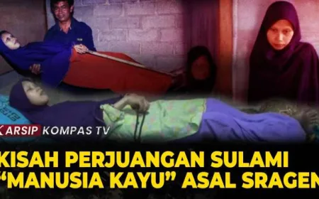 Kisah Sulami Manusia Kayu Asal Sragen Lawan Penyakit Langka Jadi Sorotan Dunia