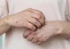 Stres Bisa Picu Tiga Penyakit Kulit Ini, Jangan Anggap Sepele
